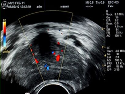 Inflammatory foci were detected in the prostate gland on ultrasound