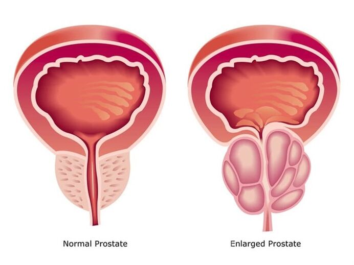 Prostovit normalizes the function and size of the prostate