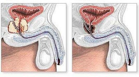 Surgically before and after the treatment of chronic prostatitis