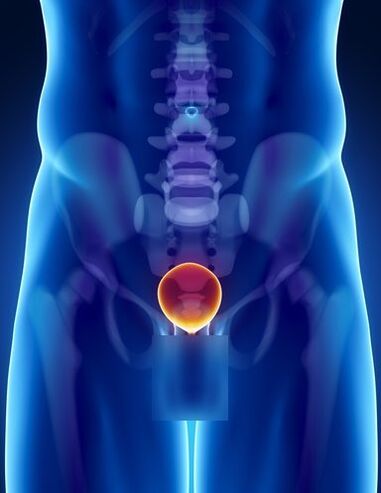 Inflammation of the prostate gland in a man with prostatitis