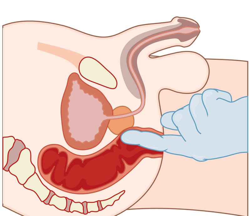 Massage with prostate postatitis