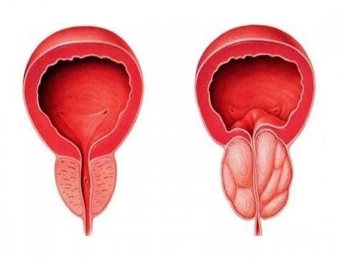 Healthy and inflammatory prostate