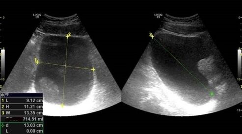 Prostatite signs for ultrasound